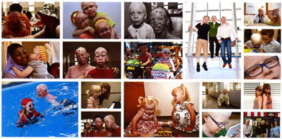 Jornada ALBA: Albinismo, una condición genética, dos realidades: España y Senegal