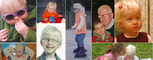 ALBA: asociacion de ayuda a personas con albinismo