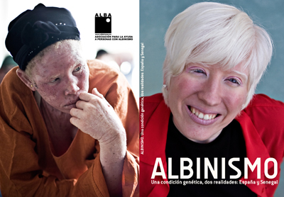 Jornada Libro ALBA: Albinismo, una condición genética, dos realidades: España y Senegal